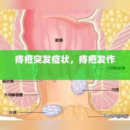 痔疮突发症状，痔疮发作 